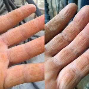 Alkaline burns of the skin from concrete wastewater