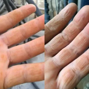 Alkaline burns of the skin from concrete wastewater